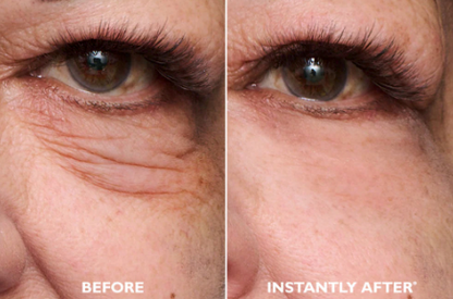 Comparison image showing the temporary cosmetic improvement in the appearance of fine lines around the under-eye area
